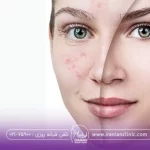 تفاوت قبل و بعد از تزریق مژول بر صورت خانم