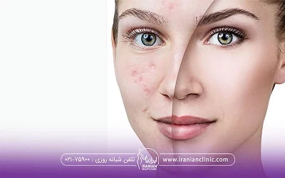 تفاوت قبل و بعد از تزریق مژول بر صورت خانم