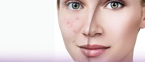 تفاوت قبل و بعد از تزریق مژول بر صورت خانم